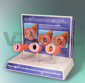 Cholesterol Build-Up Model